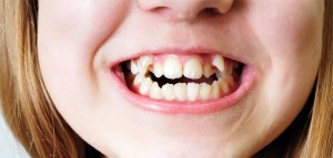 affollamento dentale nel bambino