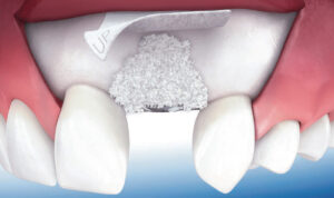 rigenerazione ossea dentale